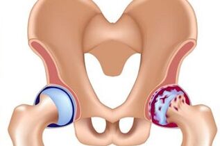 Developmental stages of osteoarthritis of the hip joint