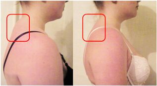 Formation of a muscle roller in cervical osteochondrosis