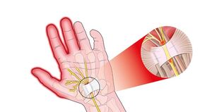 Pain in the finger joints with rhizarthrosis