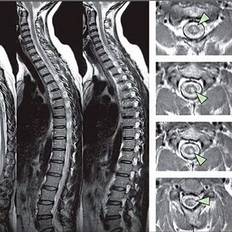 Diagnosis of thoracic osteochondrosis