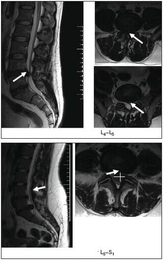 MRI scan of a herniated disc in the spine