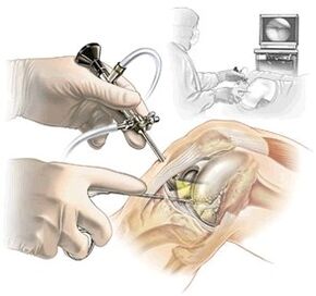 Arthroscopy for knee pain