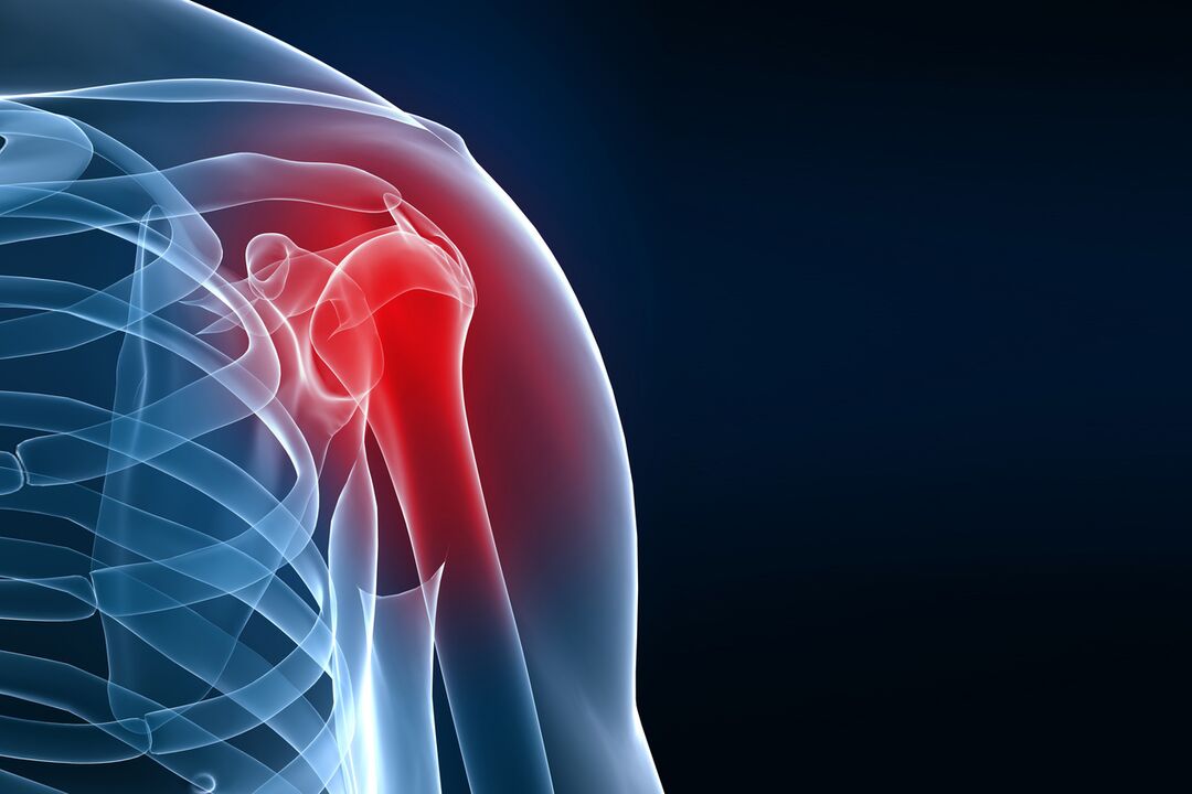 Osteoarthritis of the shoulder