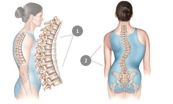 Spinal curvature as a cause of thoracic osteochondrosis