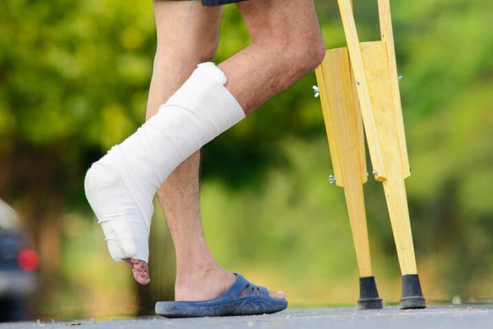 Ankle injury as a cause of osteoarthritis