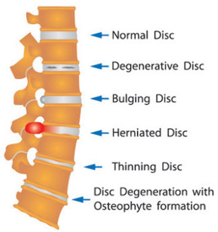 damage to intervertebral discs